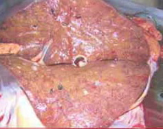 Obesity of the liver