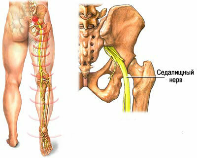 Pinch of the sciatic nerve photo