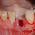 Dra tänder - hur länge helande tandkött