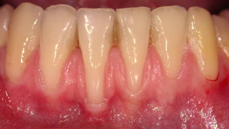 infektiöse Erkrankungen des Mund- und Zungen photo