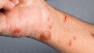 Ungüento de estelanina para hemorroides: revisiones e instrucciones de uso