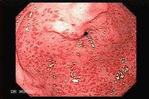 Gastritis in de maag