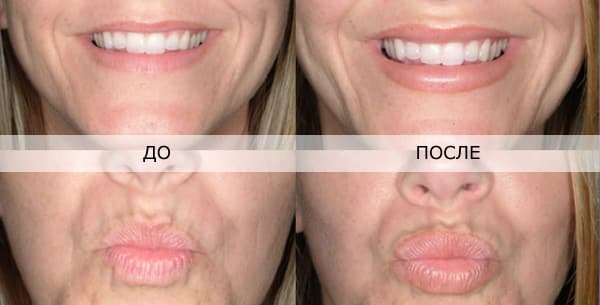 Hyaluronsäure in den Mund vor und nach Fotos