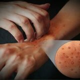 Zalm voor allergische dermatitis