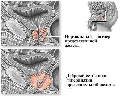 Adenom der Prostata