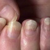 Folk Heilmittel für die Behandlung von Psoriasis der Nägel