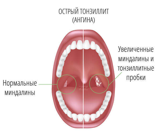 Symptoms and methods of treatment of tonsillitis during pregnancy