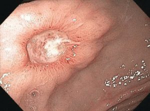 Dieet voor gastritis met hoge zuurgraad: een menu voor elke dag van de week