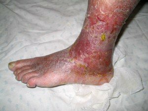 71941-trophic-ulcer-on-feet-medication-medicated