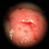 Dyskeratosis of the cervix