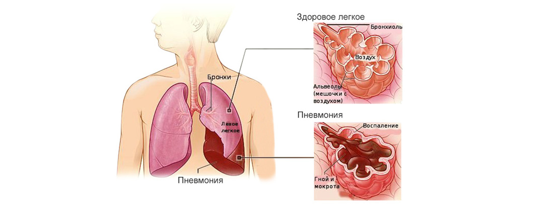 Development of viral pneumonia