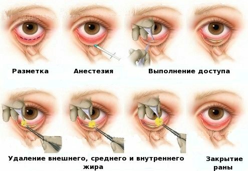 Blepharoplasty-lower eyelid