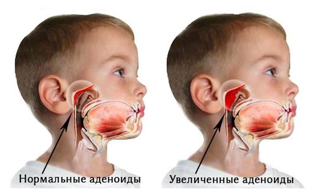 Adenoids: what they are and how to treat them in a child