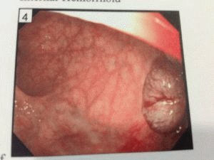 Knobbels in het rectum