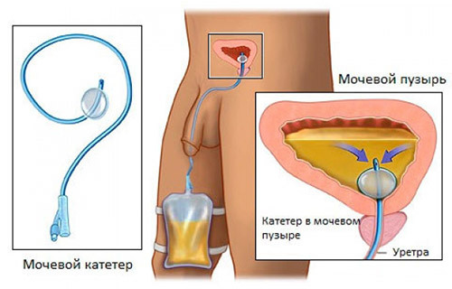Conductie van katheterisatie van de urine blaas bij mannen