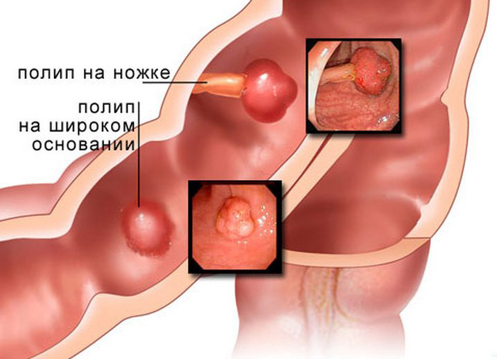 Metody pro odstranění polypů v žaludku
