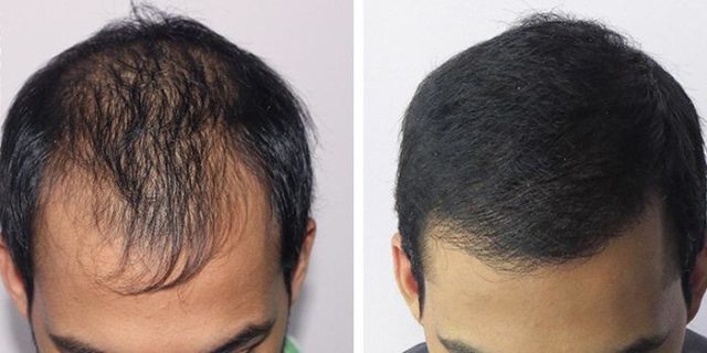 Hiusten pidennykset miehillä: miten on menettely