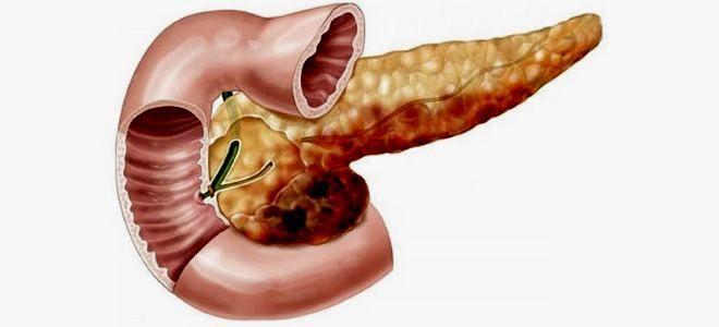 Sintomas de necrose pancreática