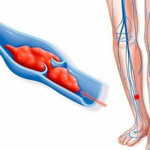 Thrombosis-leg-laser-ablation