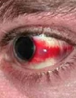 Red spots on the eyes