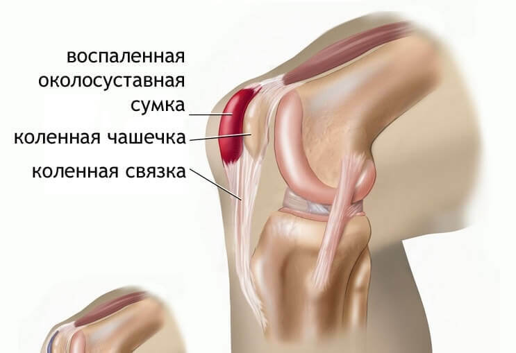 Príčiny bolesti kolena
