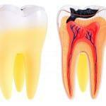 Why the wisdom tooth is not treated