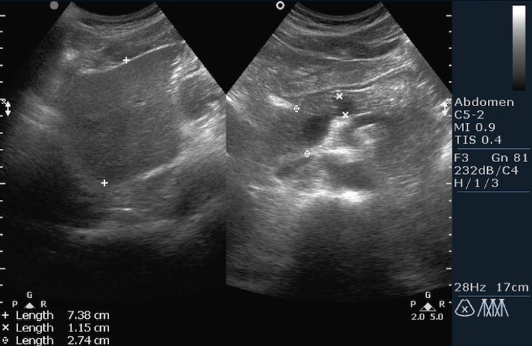 A hasnyálmirigy ultrahangjának képe
