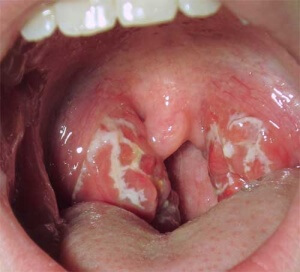 Typiske symptomer på betennelse i mandlene