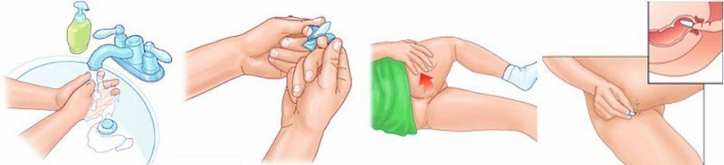 How to treat hemorrhoids at home: medication and traditional medicine