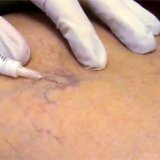 Sclerotherapy of varicose veins