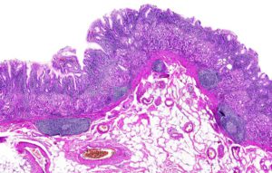 Chronic gastritis in humans