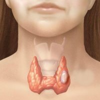 Thyroid adenoma