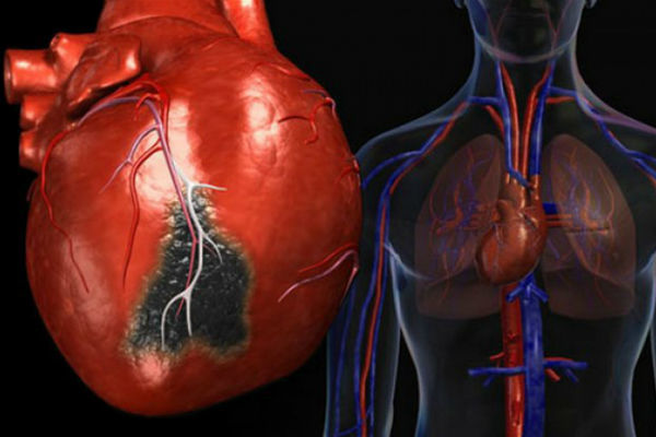 Infarkt miokarda u različitim fazama: liječenje i ishodi infarkta miokarda