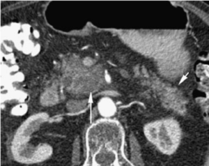 The onset of pancreatitis