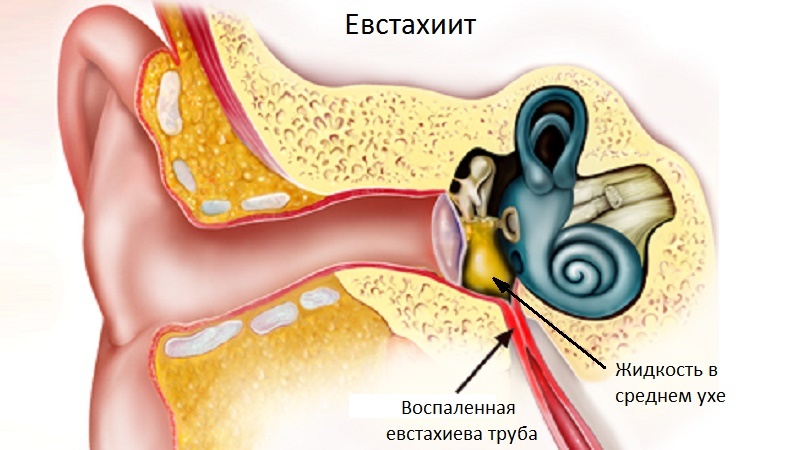 Eustachitis: Causes, Symptoms and Treatment in Adults