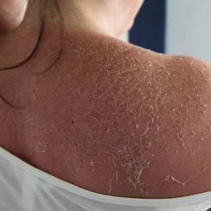 afpellen van de huid: oorzaken en behandeling