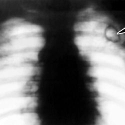 Pulmonary eosinophilia with asthmatic syndrome