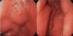 Pacijentov gastritis