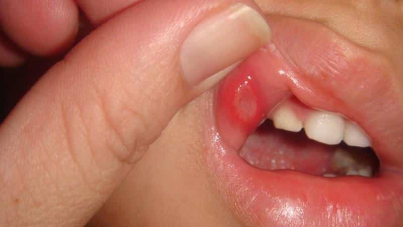 bagaimana memperlakukan dari luka putih di mulut Photo perawatan anak