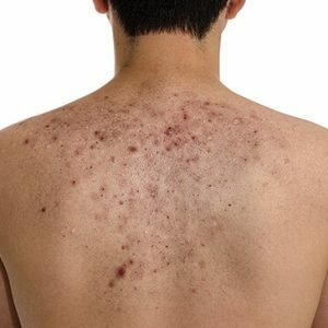 Acne on the back