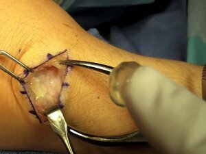 Ganglion Removal