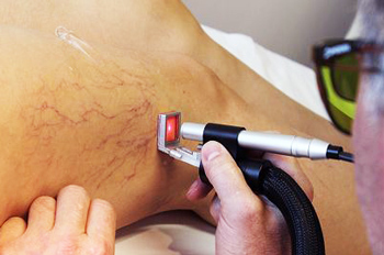 Usando um laser para tratar asteriscos vasculares