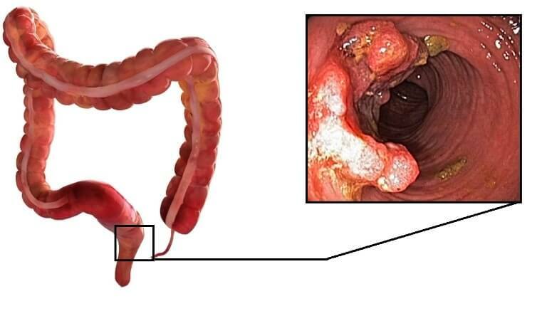adenokarcinom debelog crijeva