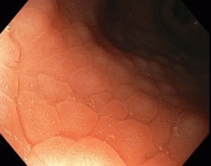 Alcohol voor gastritis: is het mogelijk om bier, wijn, wodka en cognac te drinken?