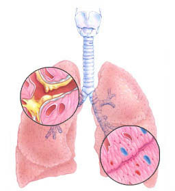 Obstruktiivne bronhiit: sümptomid ja ravi
