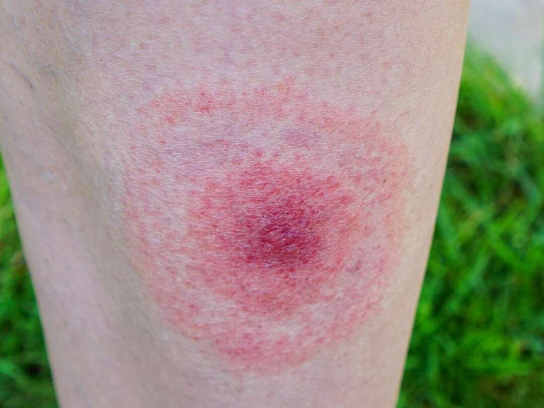 Lyme disease: what it is, causes, symptoms, treatment.