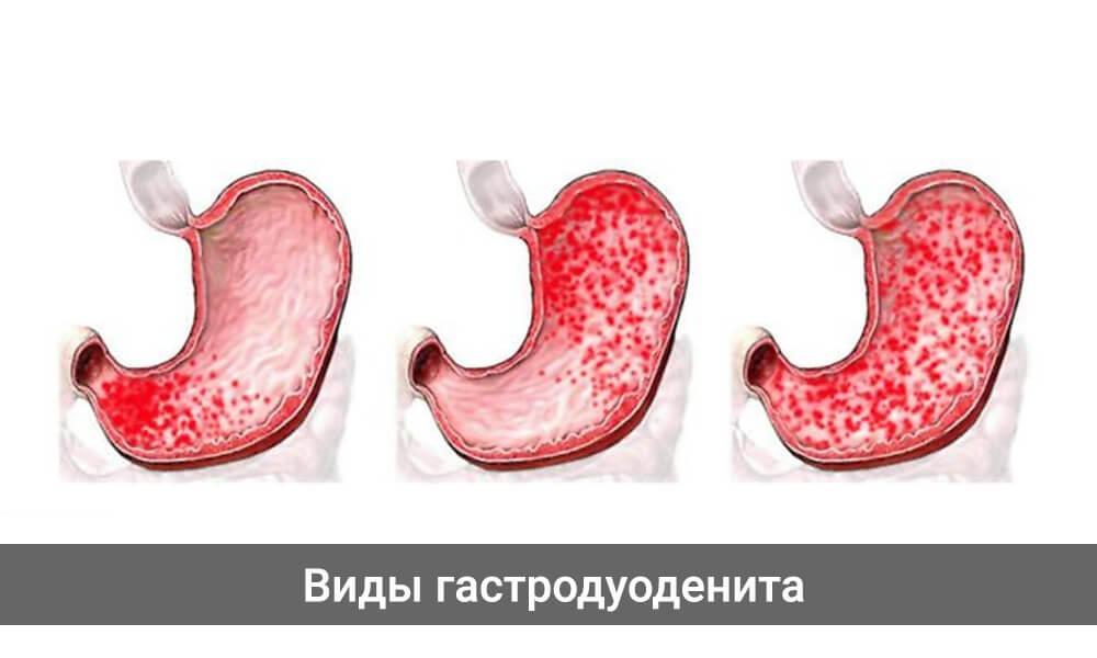 Изо рта причины желудок. Хронический антральный гастрит симптомы. Хронический атрофический гастродуоденит. Локализация хронического гастрита.