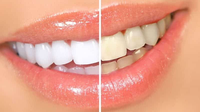Hur man gör vita tänder hemma