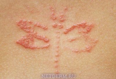 Allergische Dermatitis