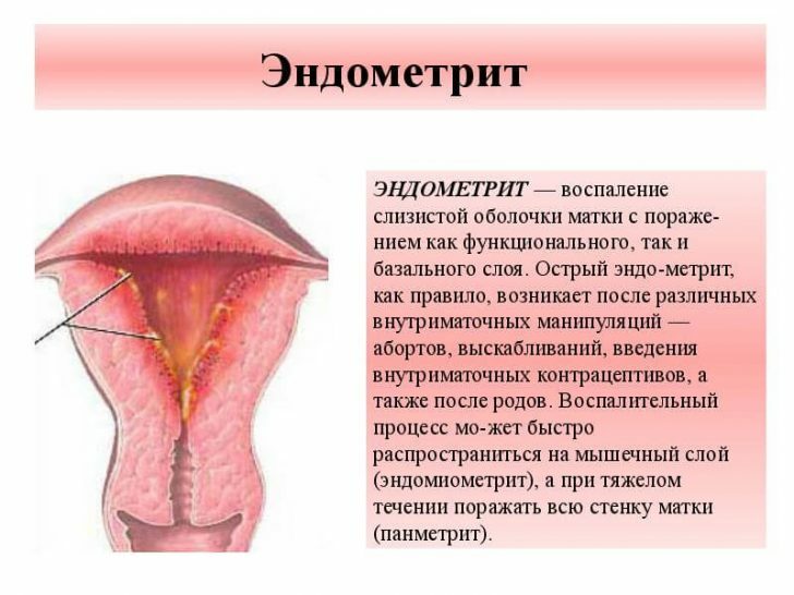 Endometritis acute and chronic: symptoms and treatment